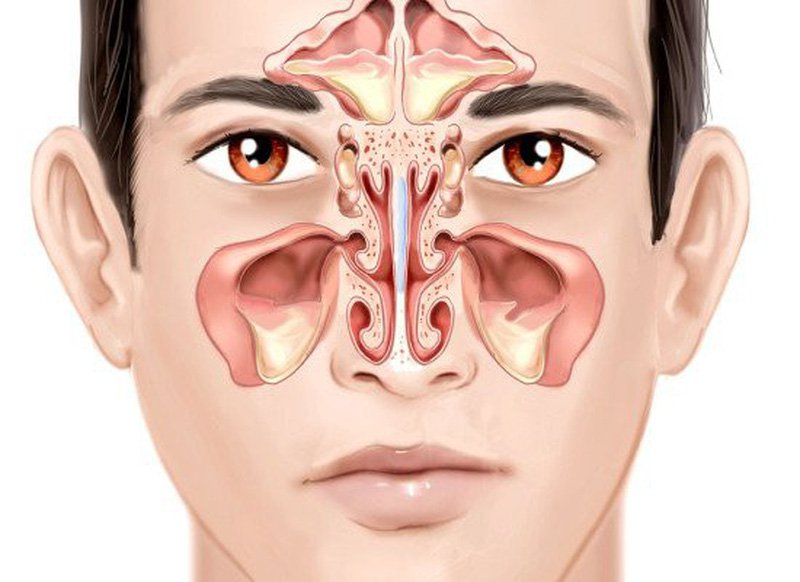 Viêm mũi dị ứng có thể dẫn đến viêm xoang cấp